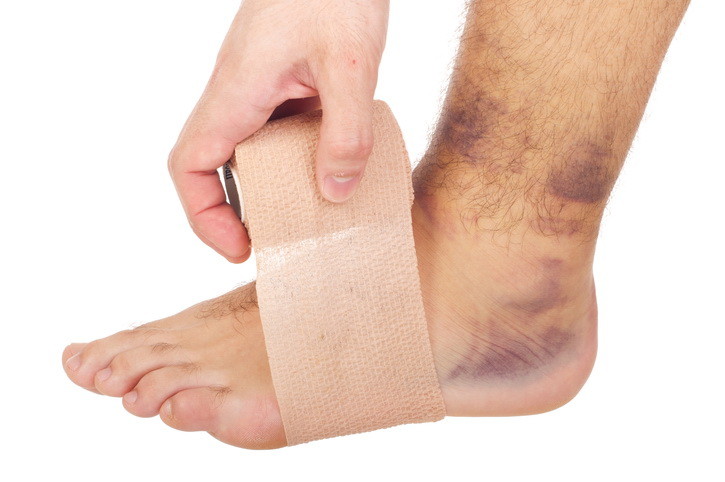 Ankle Sprain After Car Accident