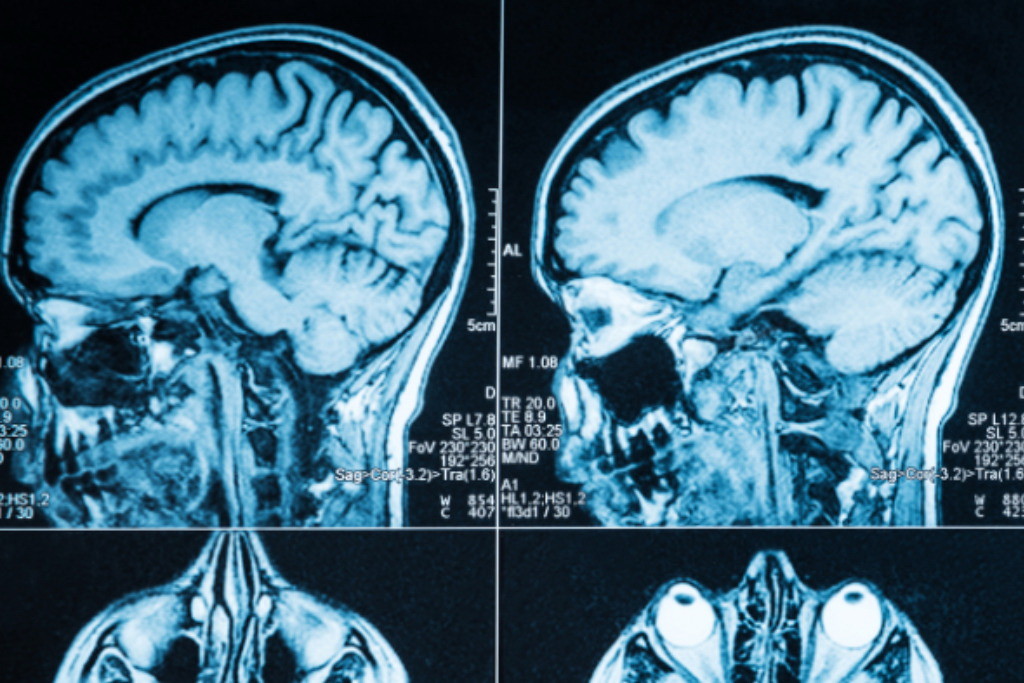 Diffuse Axonal Injury From Car Accident