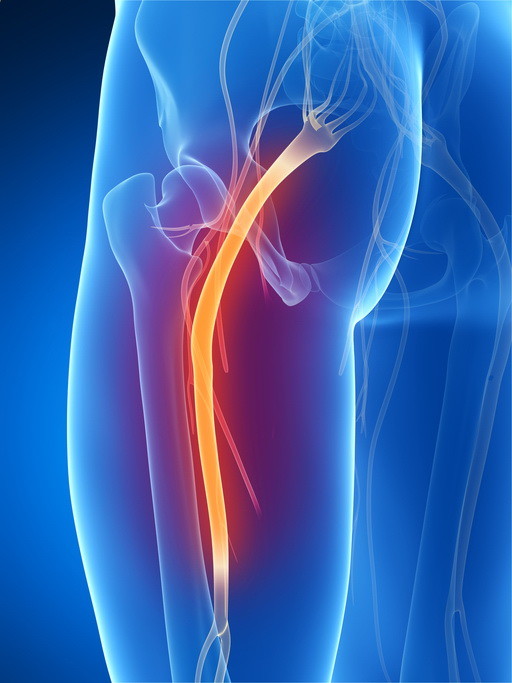 Radiating Pain Sciatica From Car Accident