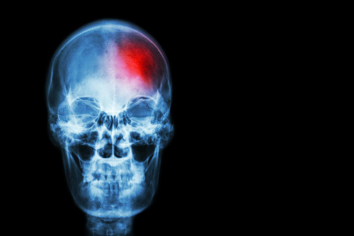 Traumatic Brain Injury After Motorcycle Accident