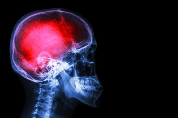 Traumatic Brain Injury From Truck Accident