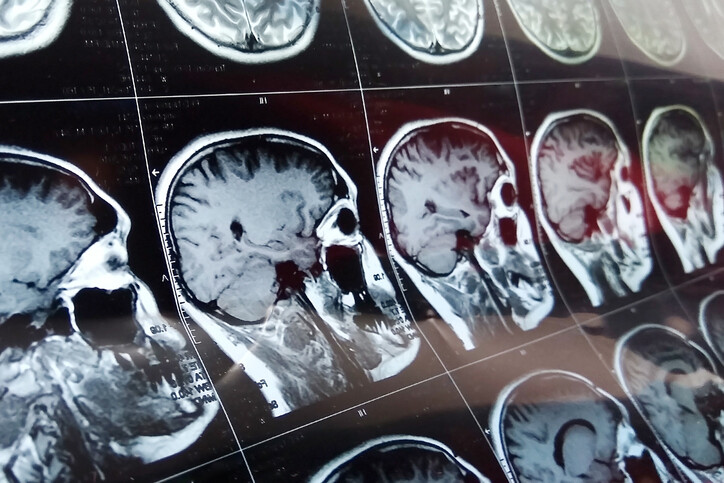 Handling a Traumatic Brain Injury Settlement