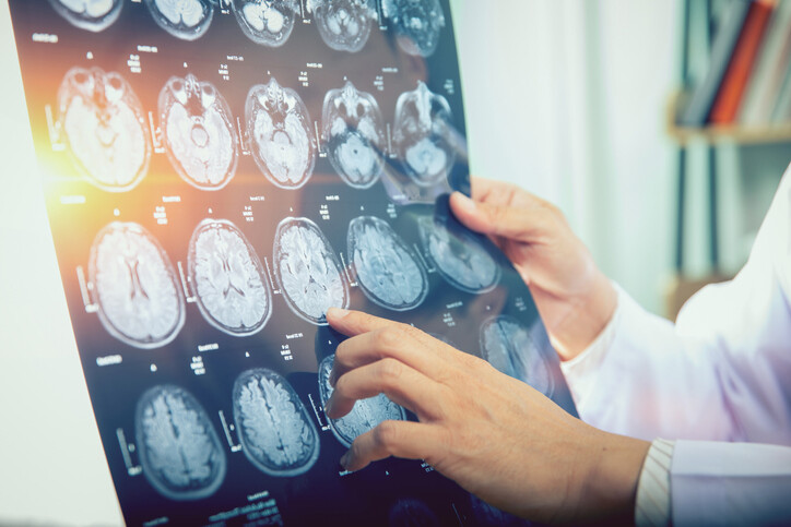 What is Considered a Traumatic Brain Injury