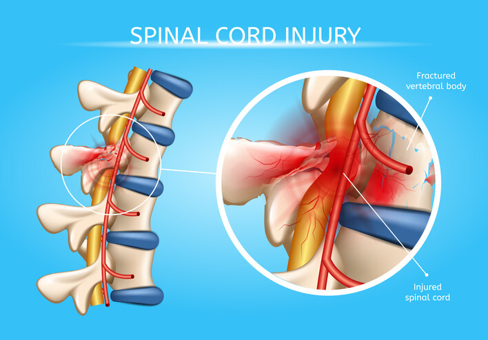 What are Some of the Different Symptoms of Spinal Cord Injuries