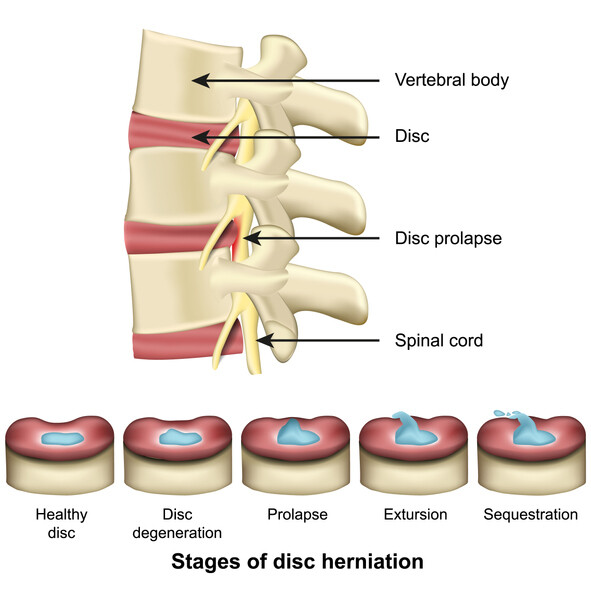 What are the Different Types of Spinal Cord Injuries