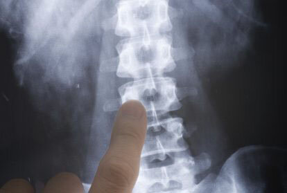 sacramento spinal cord injury attorneys