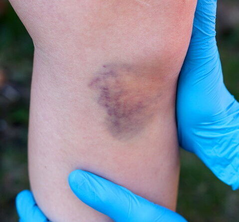 Inflamación de Rodilla Después de un Accidente de Motocicleta